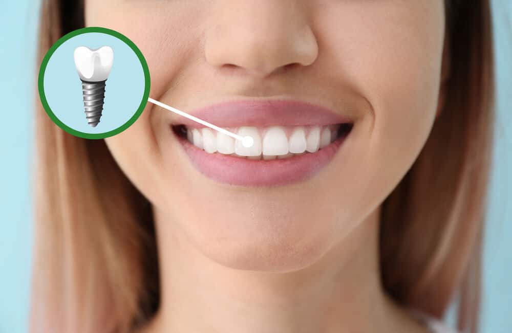 What are the Benefits of Dental Implants?